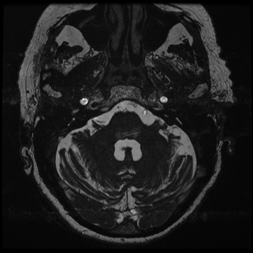 File:Balo concentric sclerosis (Radiopaedia 53875-59982 Axial T2 FIESTA 26).jpg