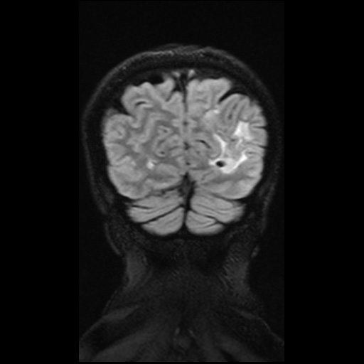 Balo concentric sclerosis (Radiopaedia 53875-59982 Coronal FLAIR 13).jpg