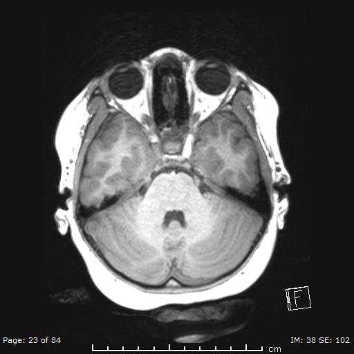 Balo concentric sclerosis (Radiopaedia 61637-69636 Axial T1 23).jpg