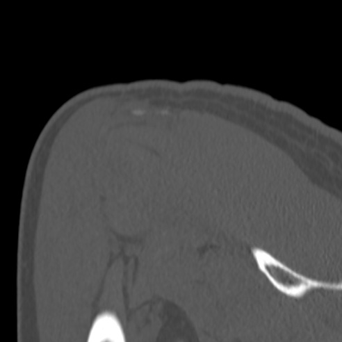 Bankart lesion (Radiopaedia 57256-64185 Coronal bone window 39).jpg