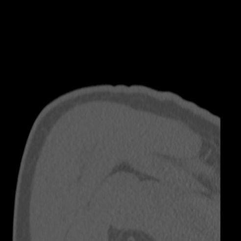 Bankart lesion (Radiopaedia 57256-64185 Coronal bone window 48).jpg