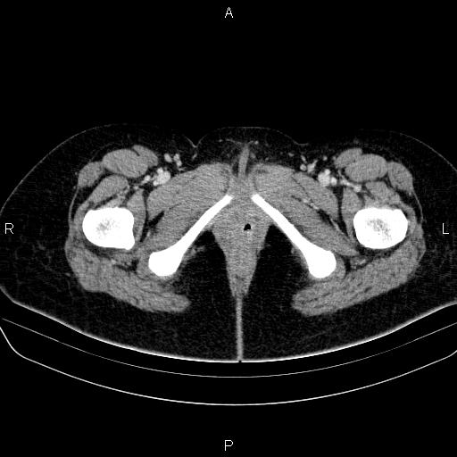 File:Bartholin gland cyst (Radiopaedia 62635-70930 Axial Post contrast 91).jpg