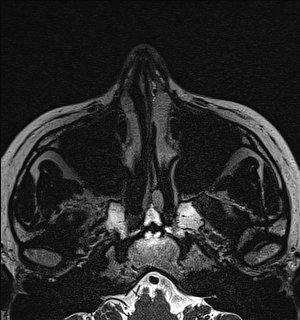 File:Basal cell carcinoma - nasal region (Radiopaedia 70292-80365 Axial Gradient Echo 20).jpg