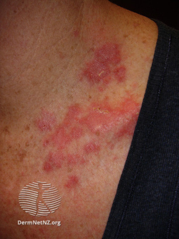 File:Basal cell carcinoma affecting the trunk (DermNet NZ lesions-bcc-trunk-0810).jpg