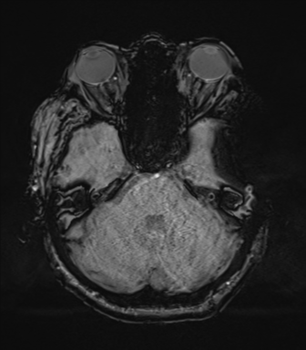 Basal ganglia metastasis (Radiopaedia 78928-91828 Axial SWI 22).png