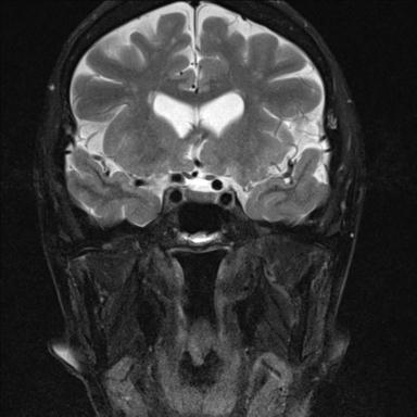 File:Base of skull chondrosarcoma (Radiopaedia 30410-31070 Coronal T2 fat sat 15).jpg