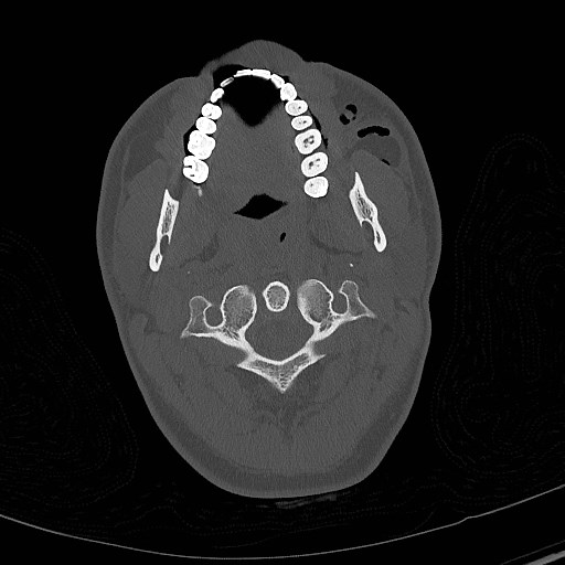 Base of skull fracture with bilateral Le Fort fractures (Radiopaedia 47094-51638 Axial bone window 10).jpg