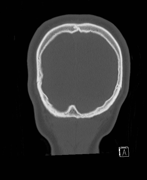 Base of skull fracture with bilateral Le Fort fractures (Radiopaedia 47094-51638 Coronal bone window 11).jpg