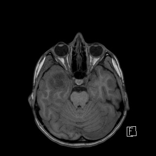 Base of skull rhabdomyosarcoma (Radiopaedia 32196-33142 Axial T1 17).jpg