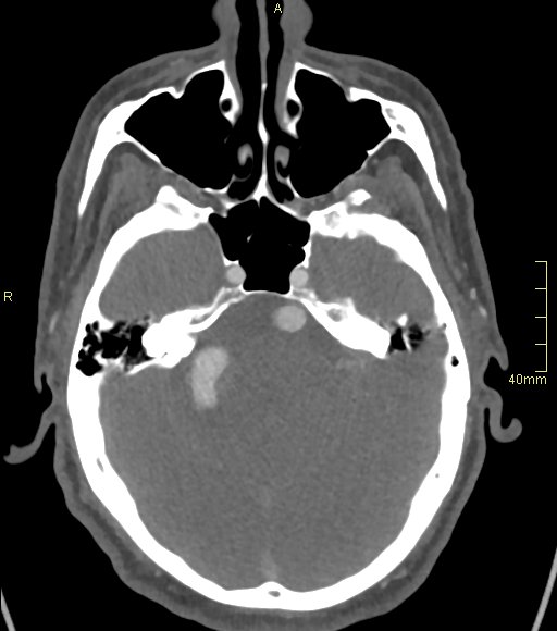 File:Basilar artery aneurysm (Radiopaedia 56261-62932 A 59).jpg