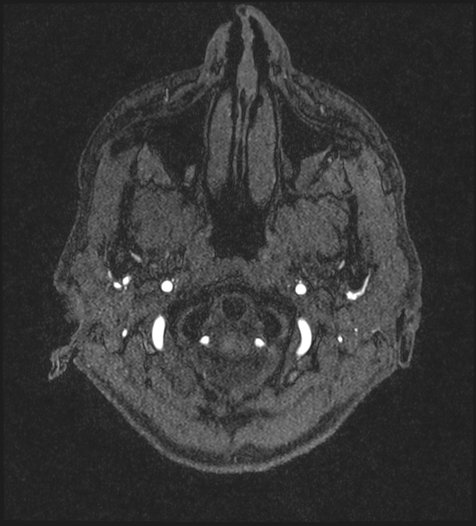 Basilar artery perforator aneurysm (Radiopaedia 82455-97733 Axial MRA 10).jpg