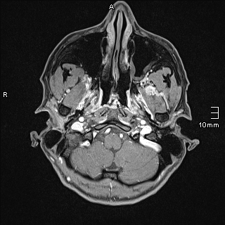 File:Basilar artery perforator aneurysm (Radiopaedia 82455-99523 G 4).jpg