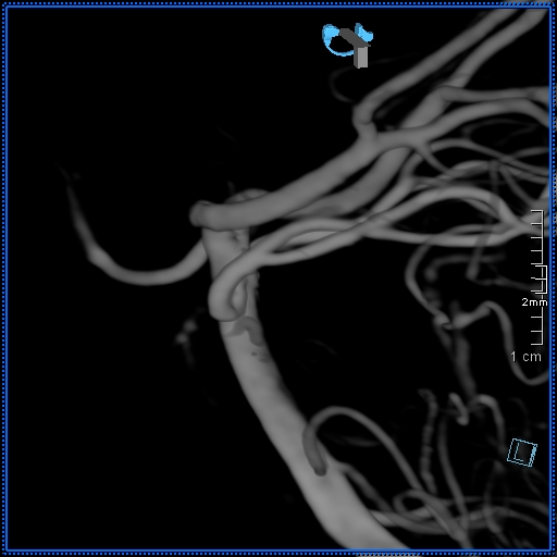 Basilar artery perforator aneurysm (Radiopaedia 82455-99524 3D Left VA 19).jpg