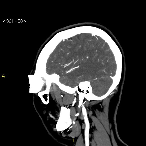 Basilar artery thrombosis (Radiopaedia 16260-15944 C 52).jpg
