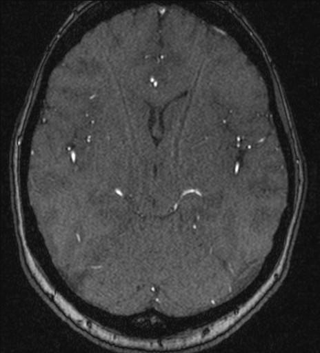 File:Basilar tip aneurysm (Radiopaedia 26504-26632 MRA 111).jpg