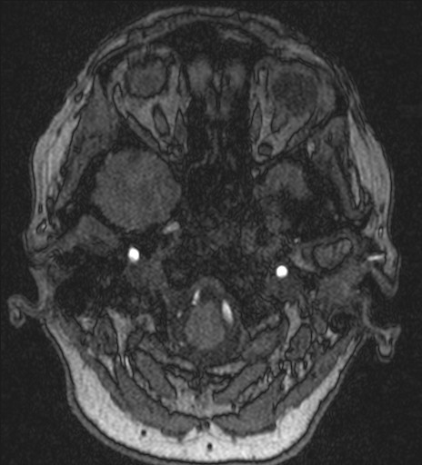 Basilar tip aneurysm (Radiopaedia 26504-26632 MRA 26).jpg