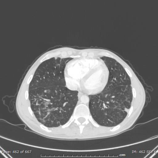 Behçet disease (Radiopaedia 44247-47889 Axial lung window 63).jpg
