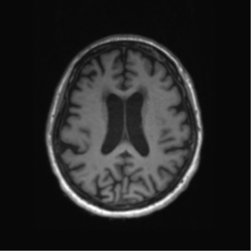 Behavioral variant frontotemporal dementia and late onset schizophrenia (Radiopaedia 52197-58083 Axial T1 36).png