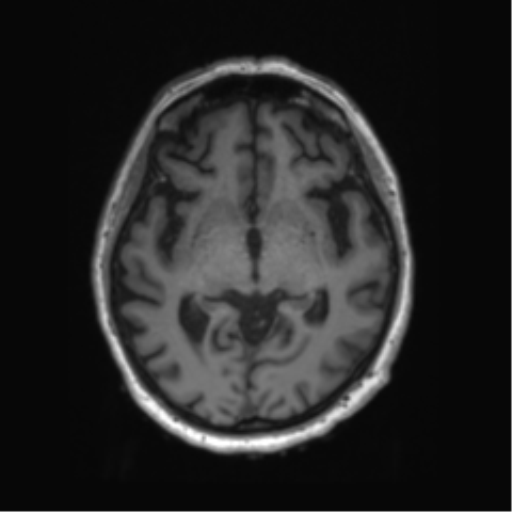 Behavioral variant frontotemporal dementia and late onset schizophrenia (Radiopaedia 52197-58083 Axial T1 57).png