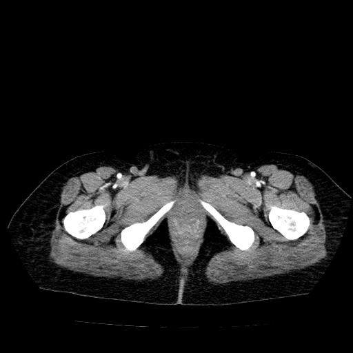 Benign spindle cell tumor - abdominopelvic (Radiopaedia 61300-69212 A 62).jpg