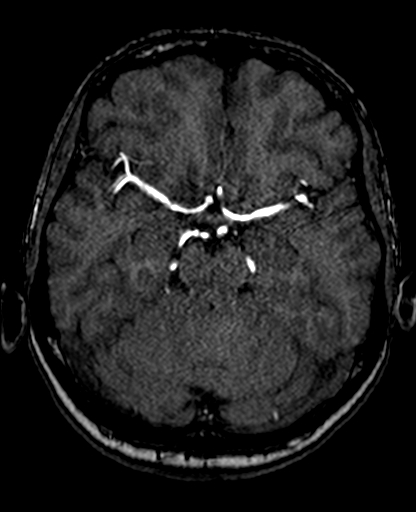 Berry aneurysm of the terminal internal carotid artery (Radiopaedia 88286-104918 Axial TOF 100).jpg