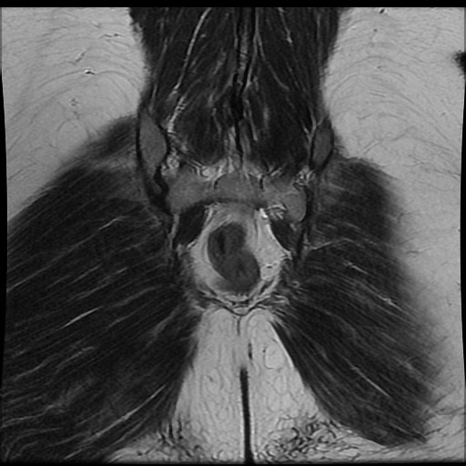 File:Bicornuate uterus (Radiopaedia 51676-57472 Coronal T2 24).jpg
