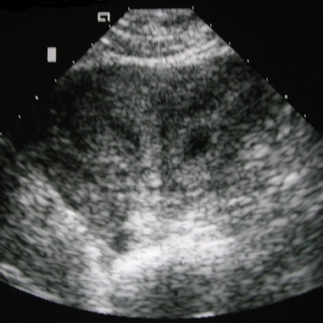 File:Bicornuate uterus with early intrauterine pregnancy (Radiopaedia 23599-23714 A 1).jpeg