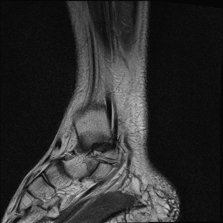 File:Bilateral Achilles tendon complete tear (Radiopaedia 81344-95051 Sagittal T2 14).jpg
