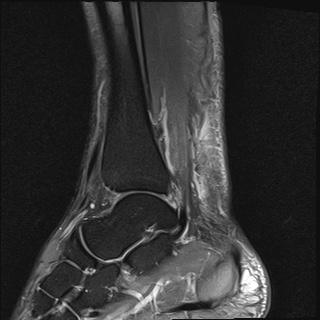 File:Bilateral Achilles tendon complete tear (Radiopaedia 81344-95051 Sagittal T2 fat sat 11).jpg