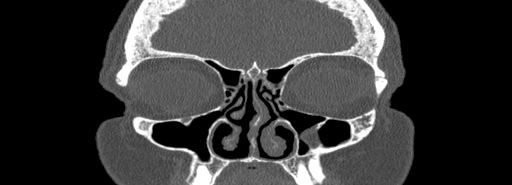 Bilateral Ectopic Infraorbital Nerves (Radiopaedia 49006-54084 Coronal bone window 18).jpg