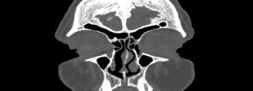 File:Bilateral Ectopic Infraorbital Nerves (Radiopaedia 49006-54084 Coronal bone window 5).jpg