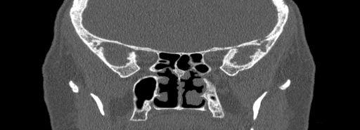 Bilateral Ectopic Infraorbital Nerves (Radiopaedia 49006-54084 Coronal bone window 58).jpg