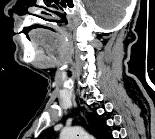 Bilateral Warthin tumors (Radiopaedia 84034-99263 D 48).jpg