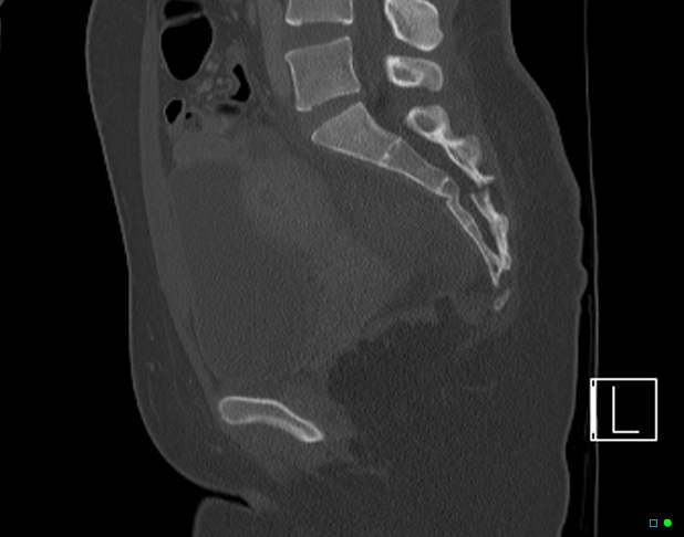 Bilateral acetabular fractures (Radiopaedia 79272-92308 Sagittal bone window 49).jpg