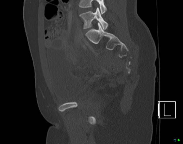 Bilateral acetabular fractures (Radiopaedia 79272-92308 Sagittal bone window 53).jpg