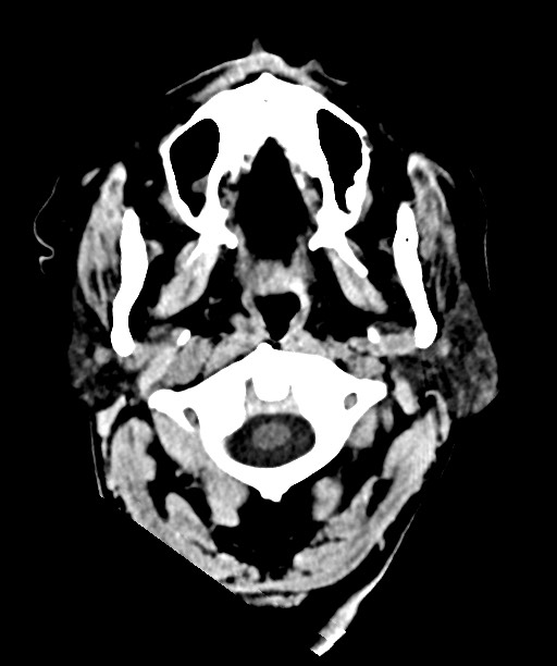 Bilateral acute on chronic subdural hematomas (Radiopaedia 78466-91146 Axial non-contrast 6).jpg