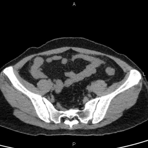 Bilateral adrenal gland hyperenhancement in pancreatitis (Radiopaedia 86642-102753 Axial non-contrast 88).jpg