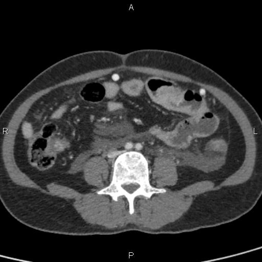 Bilateral adrenal gland hyperenhancement in pancreatitis (Radiopaedia 86642-102753 E 70).jpg