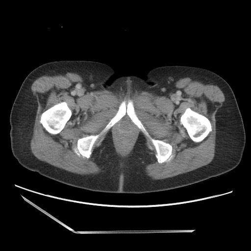File:Bilateral adrenal granulocytic sarcomas (chloromas) (Radiopaedia 78375-91007 Axial 112).jpg