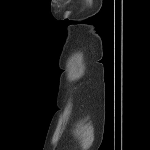 Bilateral adrenal granulocytic sarcomas (chloromas) (Radiopaedia 78375-91007 C 18).jpg