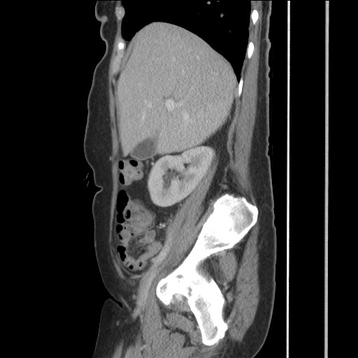 Bilateral adrenal granulocytic sarcomas (chloromas) (Radiopaedia 78375-91007 C 50).jpg