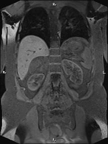 File:Bilateral adrenal myelolipoma (Radiopaedia 63058-71537 Coronal T1 fat sat 35).jpg