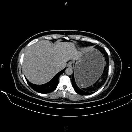 Bilateral benign adrenal adenomas (Radiopaedia 86912-103124 Axial non-contrast 21).jpg