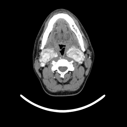 Bilateral carotid body tumors (Radiopaedia 52899-58827 A 18).jpg