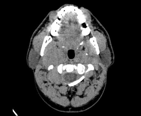 Bilateral carotid body tumors (Radiopaedia 61841-69870 Axial non-contrast 26).jpg
