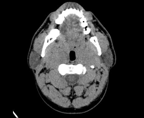File:Bilateral carotid body tumors (Radiopaedia 61841-69870 Axial non-contrast 29).jpg