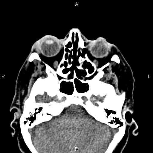 File:Bilateral enlargement of lacrimal glands - sarcoidosis (Radiopaedia 62627-70921 Axial non-contrast 33).jpg
