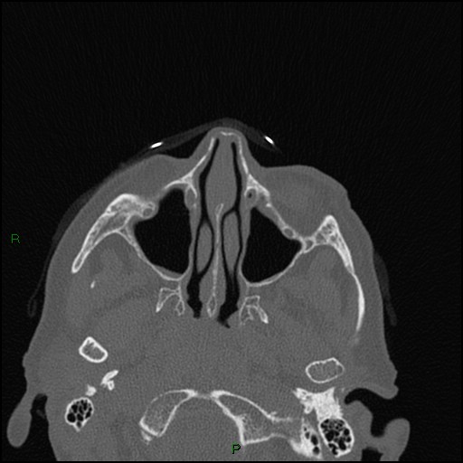 Bilateral frontal mucoceles (Radiopaedia 82352-96454 Axial bone window 183).jpg
