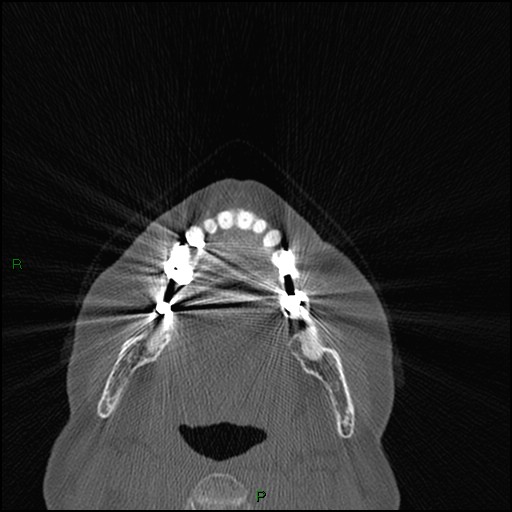 Bilateral frontal mucoceles (Radiopaedia 82352-96454 Axial bone window 277).jpg