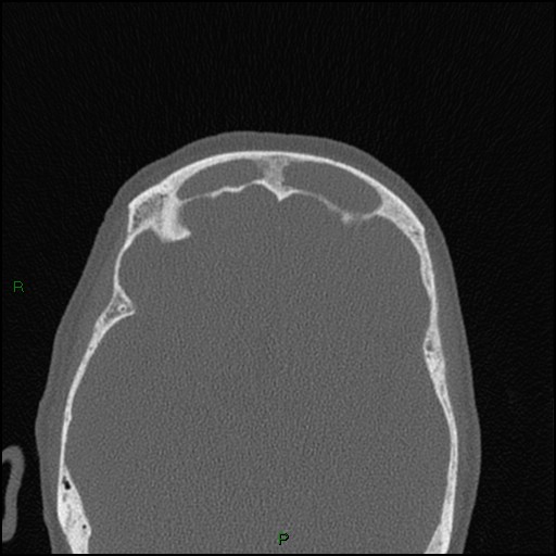 Bilateral frontal mucoceles (Radiopaedia 82352-96454 Axial bone window 96).jpg